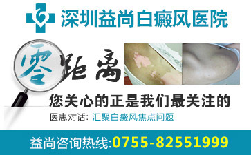 在深圳有白癫风医院吗？节段型白癜风要怎么进行预防